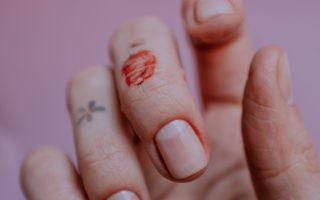 Mycose de l’ongle : causes et traitements médicaux