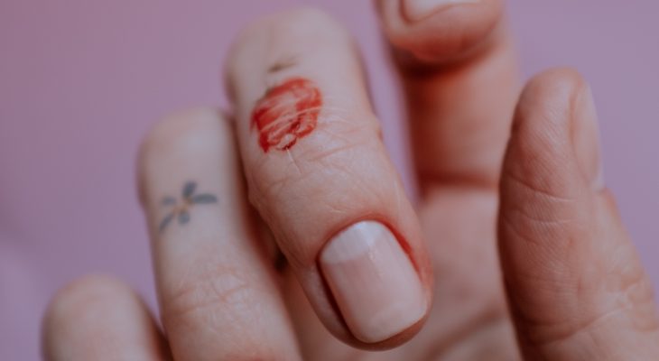 Mycose de l’ongle : causes et traitements médicaux